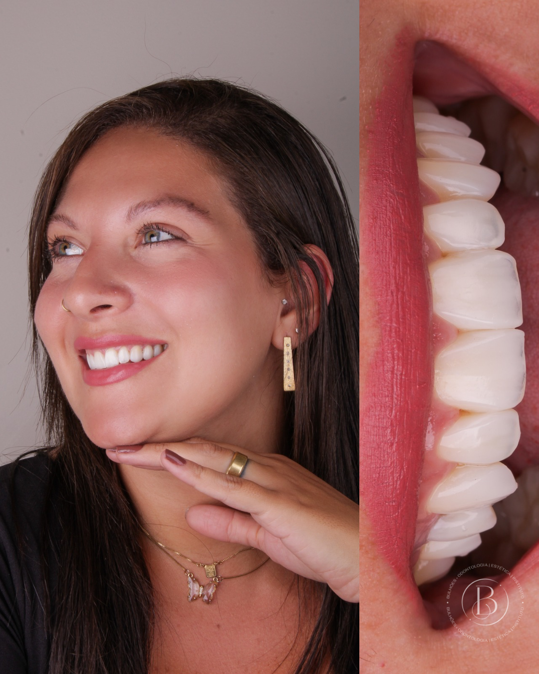 Caso de lentes de contato dental 1